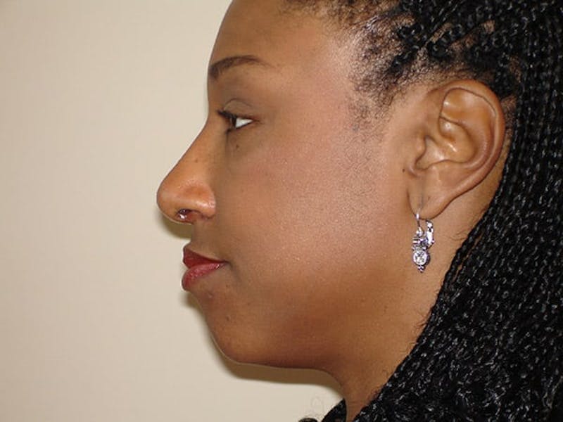 Rhinoplasty Before & After Gallery - Patient 133066716 - Image 4