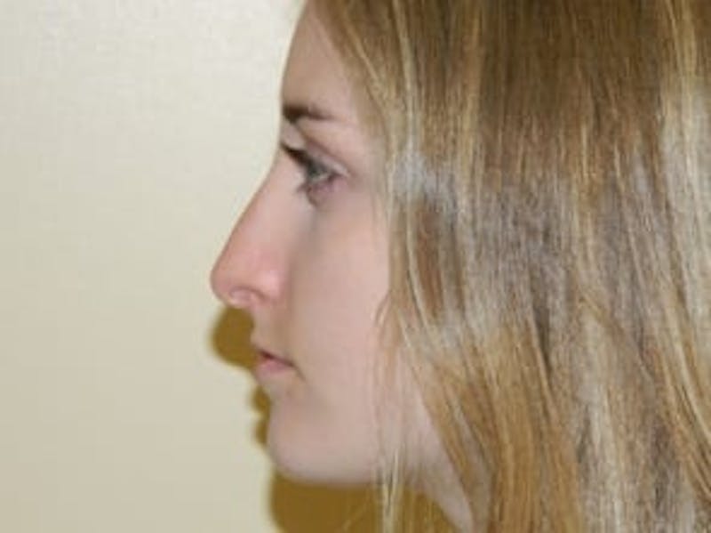 Rhinoplasty Before & After Gallery - Patient 133066718 - Image 1