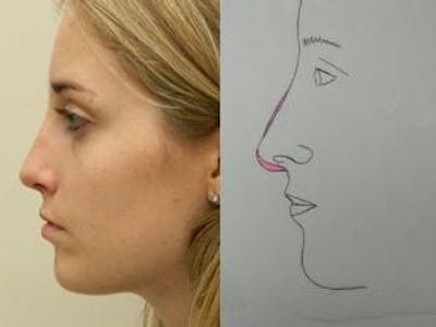 Rhinoplasty Before & After Gallery - Patient 133066718 - Image 2