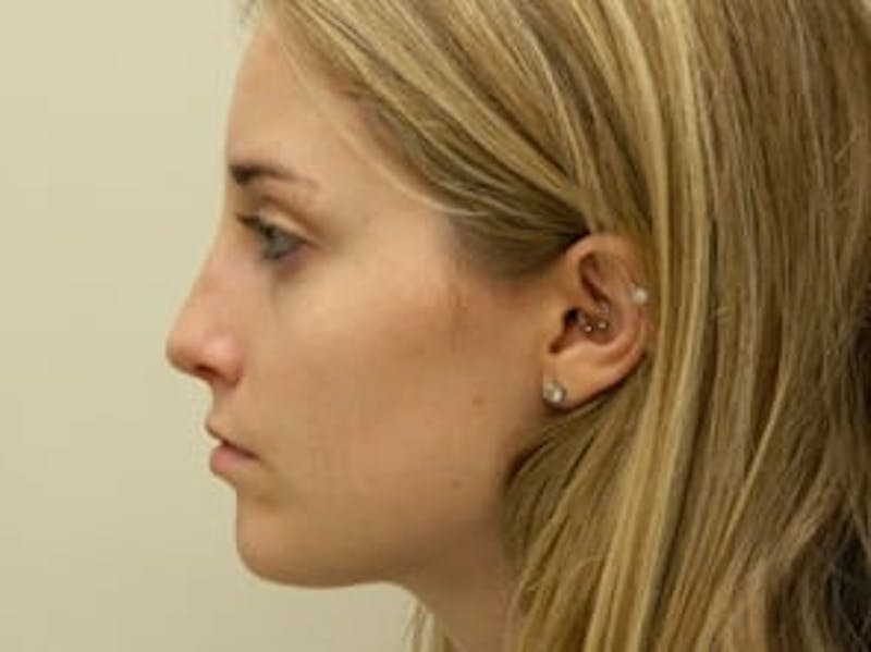 Rhinoplasty Before & After Gallery - Patient 133066718 - Image 4