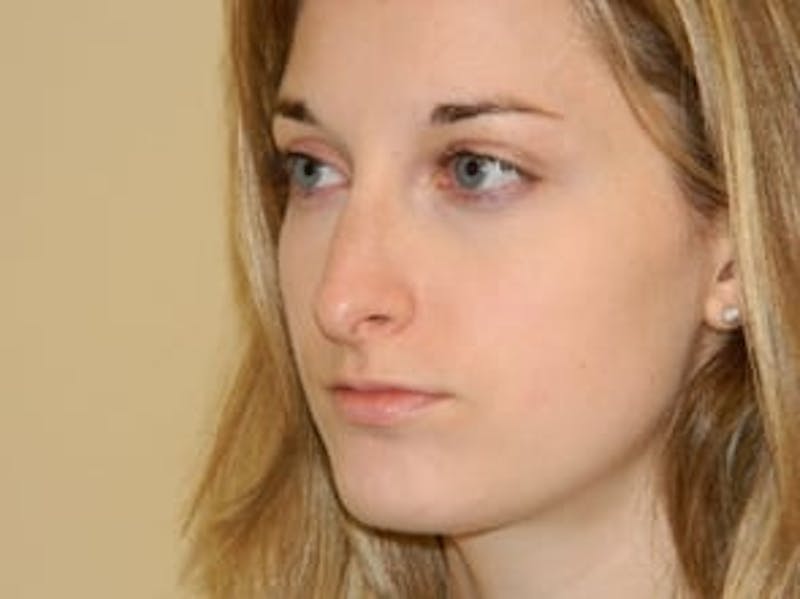 Rhinoplasty Before & After Gallery - Patient 133066718 - Image 5