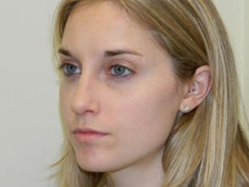 Rhinoplasty Before & After Gallery - Patient 133066718 - Image 6