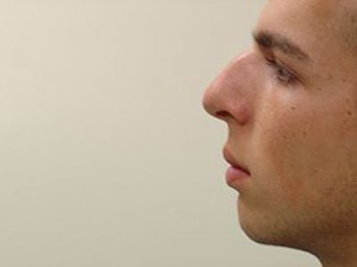 Rhinoplasty Before & After Gallery - Patient 133066721 - Image 1