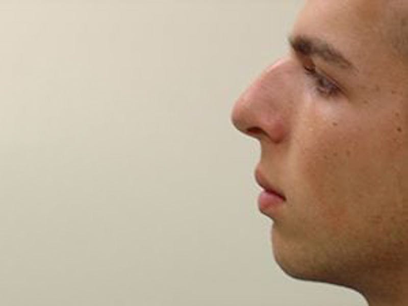 Rhinoplasty Before & After Gallery - Patient 133066721 - Image 1