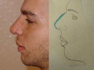 Rhinoplasty Before & After Gallery - Patient 133066721 - Image 2