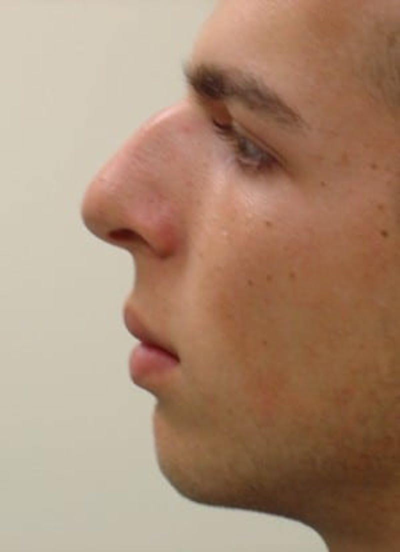 Rhinoplasty Before & After Gallery - Patient 133066721 - Image 3