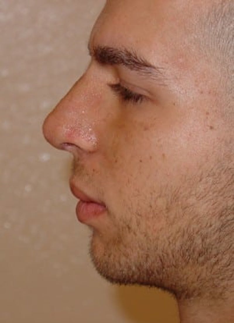 Rhinoplasty Before & After Gallery - Patient 133066721 - Image 4