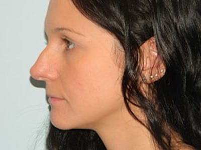 Rhinoplasty Before & After Gallery - Patient 133066722 - Image 1