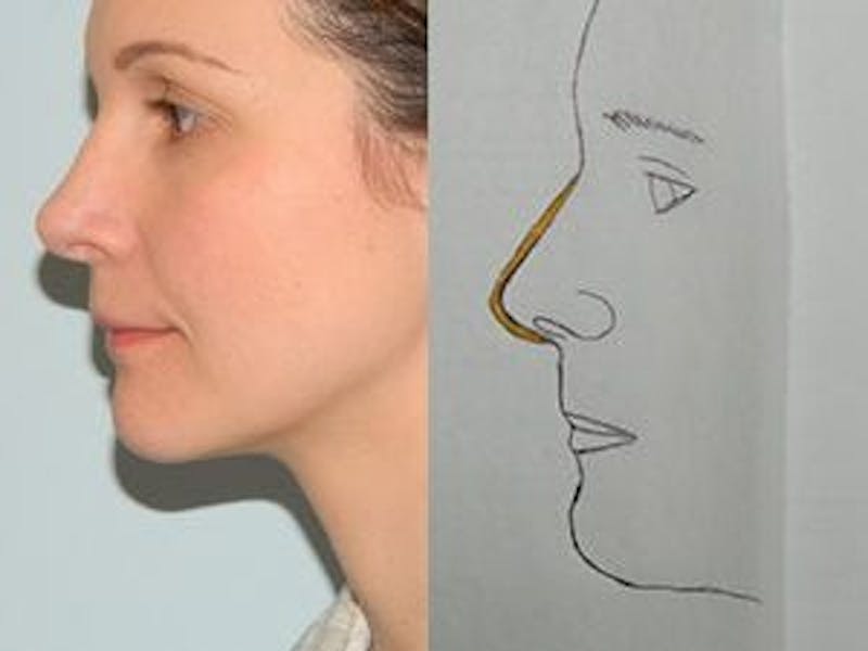 Rhinoplasty Before & After Gallery - Patient 133066722 - Image 2