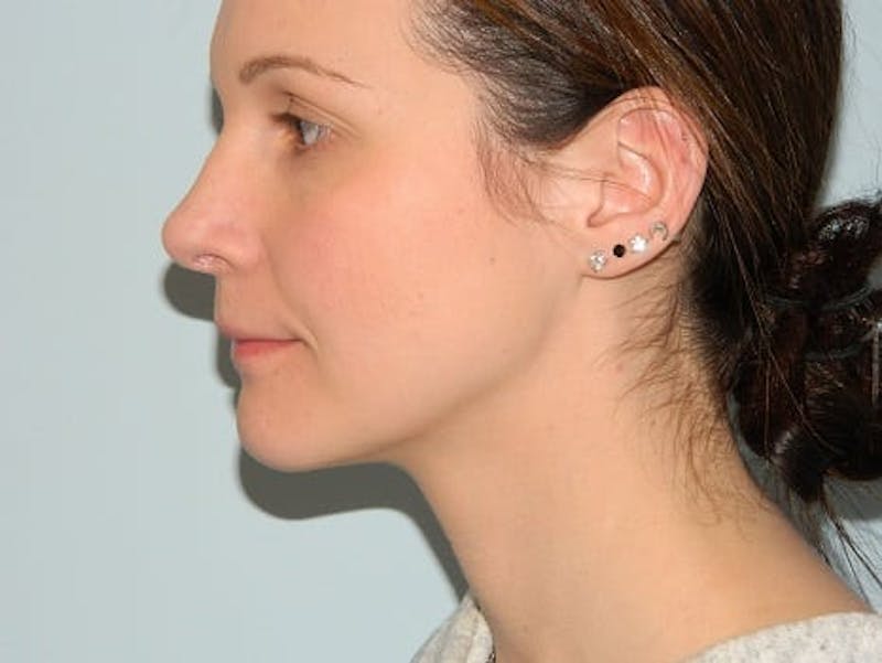 Rhinoplasty Before & After Gallery - Patient 133066722 - Image 4