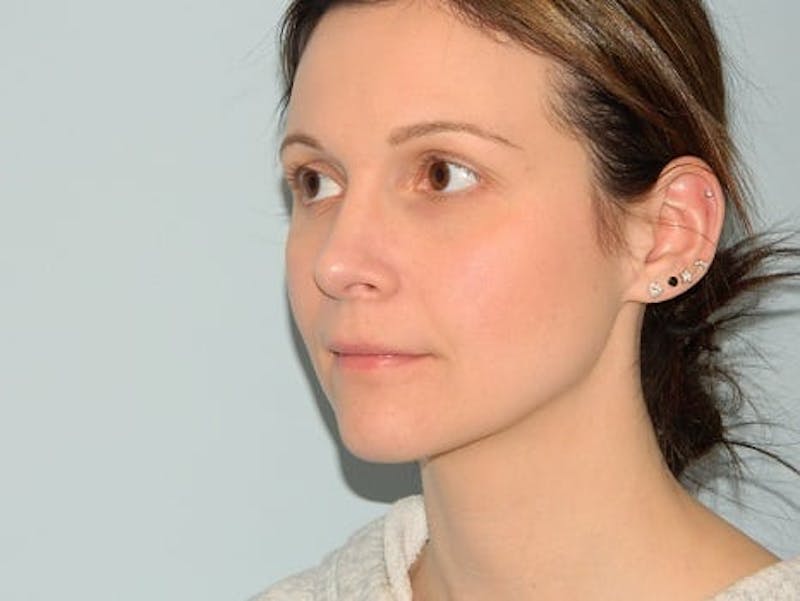 Rhinoplasty Before & After Gallery - Patient 133066722 - Image 6