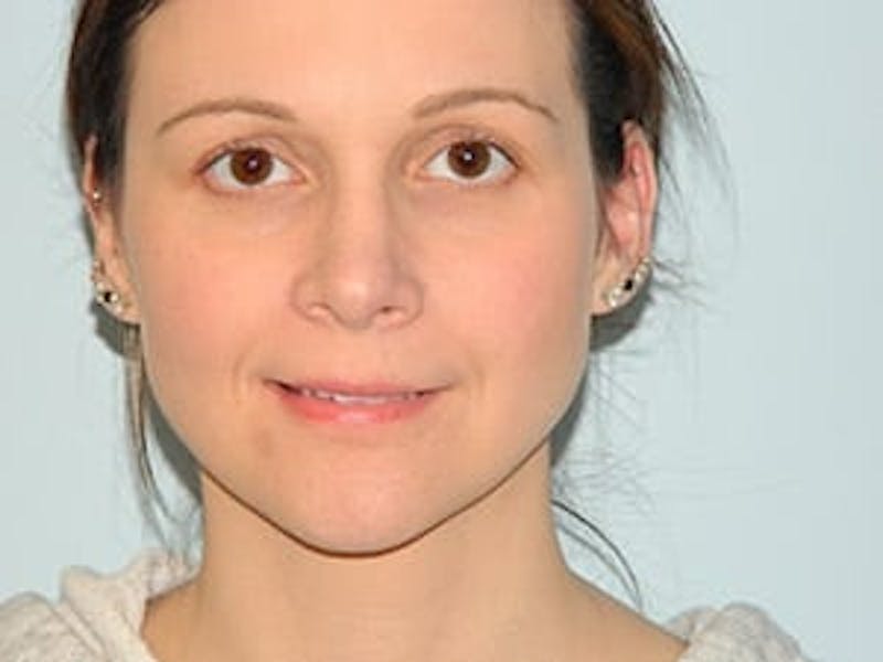 Rhinoplasty Before & After Gallery - Patient 133066722 - Image 8