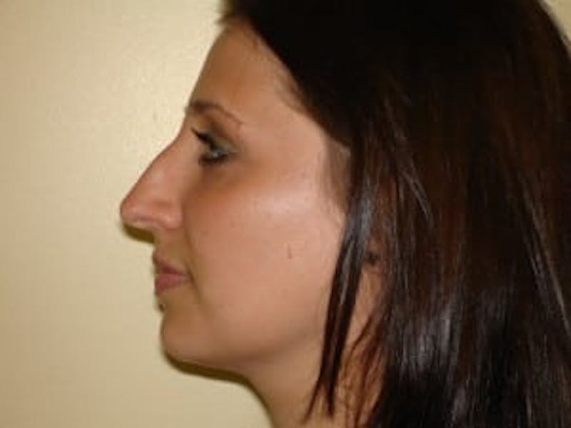 Rhinoplasty Before & After Gallery - Patient 133066723 - Image 1