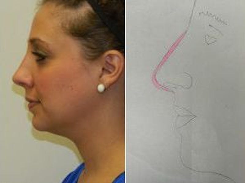 Rhinoplasty Before & After Gallery - Patient 133066723 - Image 2