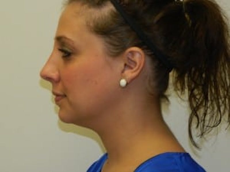 Rhinoplasty Before & After Gallery - Patient 133066723 - Image 4