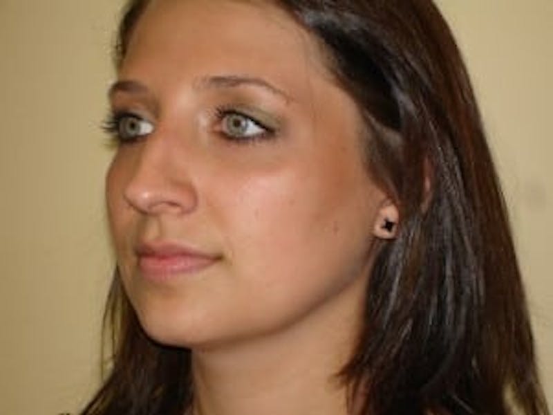 Rhinoplasty Before & After Gallery - Patient 133066723 - Image 5