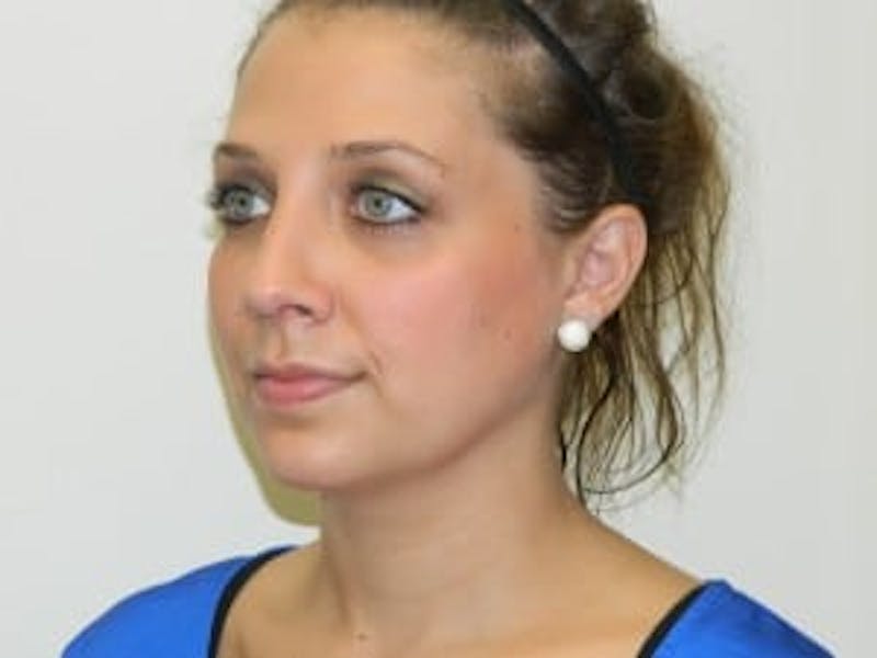 Rhinoplasty Before & After Gallery - Patient 133066723 - Image 6