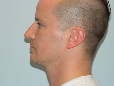 Rhinoplasty Before & After Gallery - Patient 133066725 - Image 1