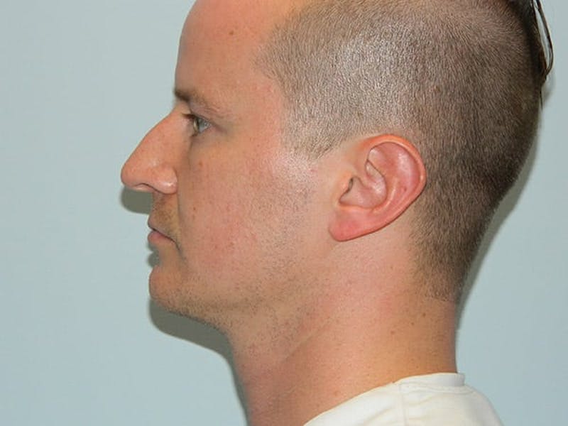 Rhinoplasty Before & After Gallery - Patient 133066725 - Image 1
