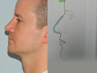 Rhinoplasty Before & After Gallery - Patient 133066725 - Image 2