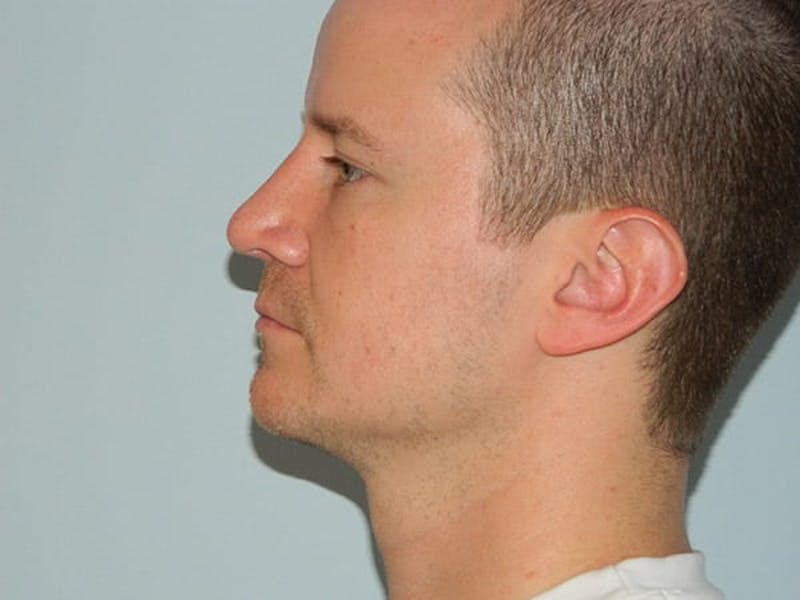 Rhinoplasty Before & After Gallery - Patient 133066725 - Image 4