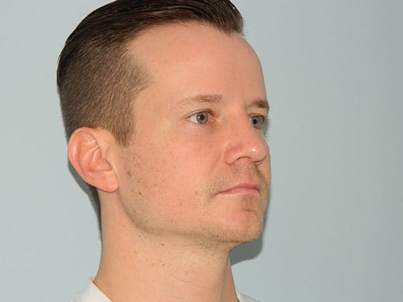 Rhinoplasty Before & After Gallery - Patient 133066725 - Image 6