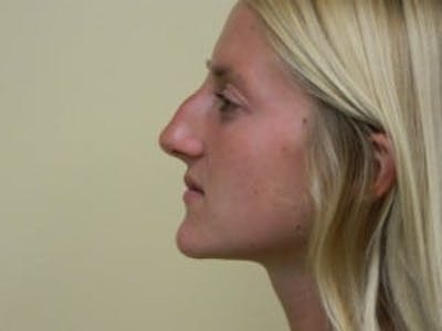 Rhinoplasty Before & After Gallery - Patient 133066726 - Image 1