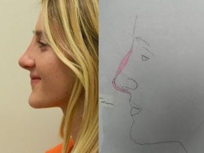 Rhinoplasty Before & After Gallery - Patient 133066726 - Image 2