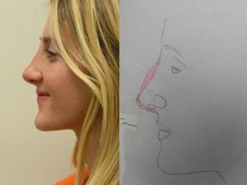 Rhinoplasty Before & After Gallery - Patient 133066726 - Image 2
