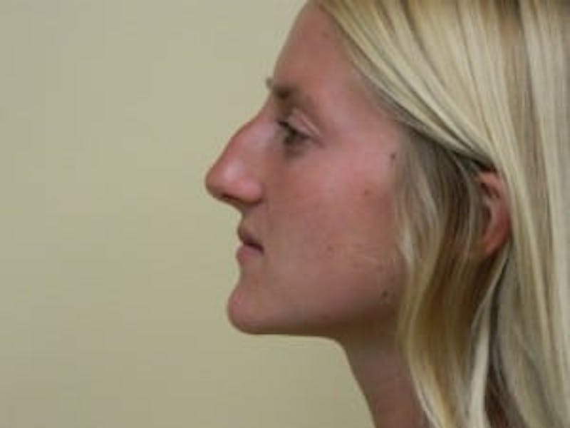 Rhinoplasty Before & After Gallery - Patient 133066726 - Image 3