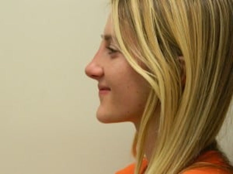 Rhinoplasty Before & After Gallery - Patient 133066726 - Image 4