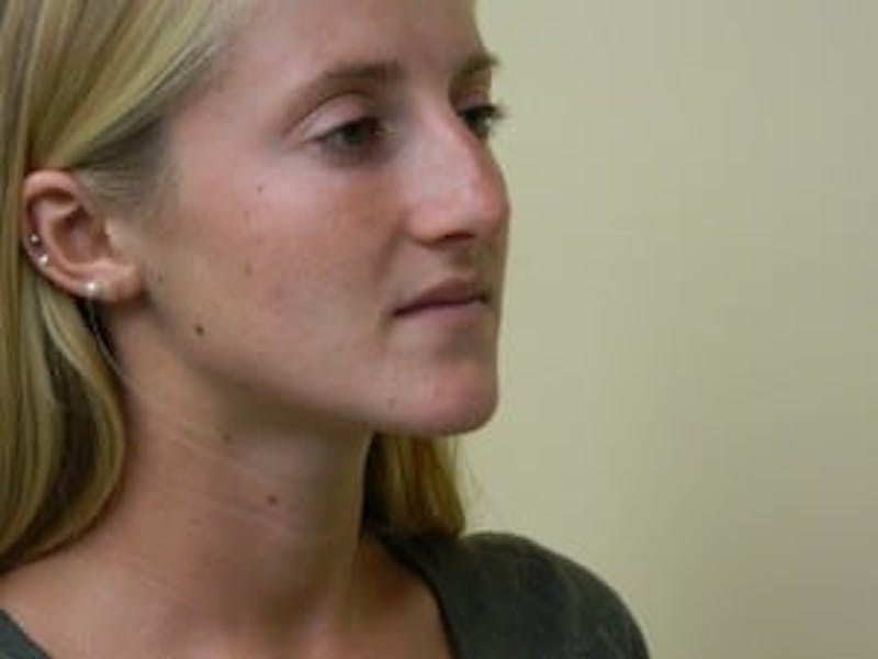 Rhinoplasty Before & After Gallery - Patient 133066726 - Image 5