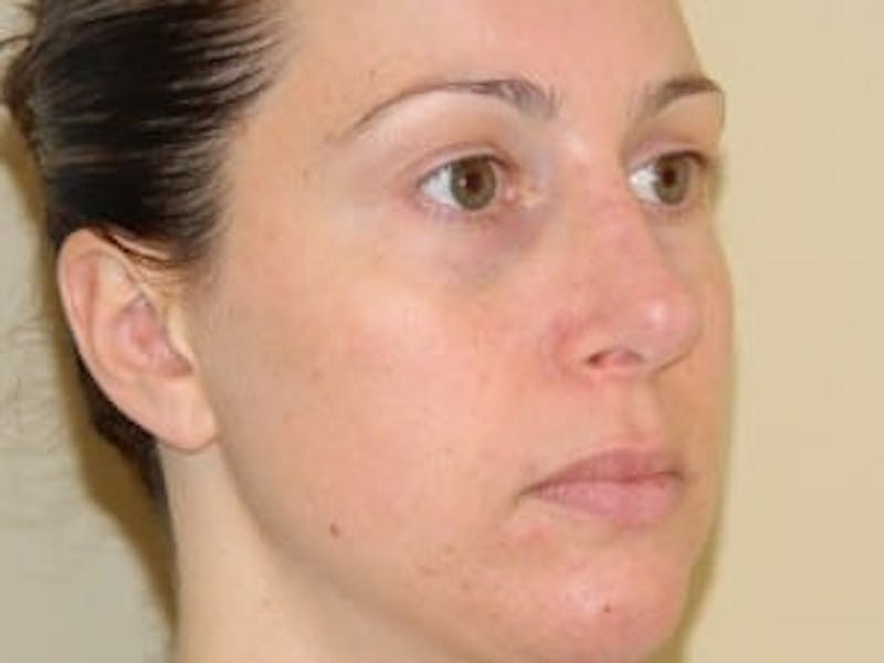 Rhinoplasty Before & After Gallery - Patient 133066730 - Image 6