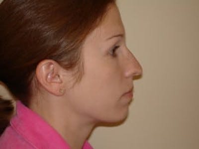 Rhinoplasty Before & After Gallery - Patient 133066731 - Image 1