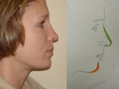 Rhinoplasty Before & After Gallery - Patient 133066731 - Image 2