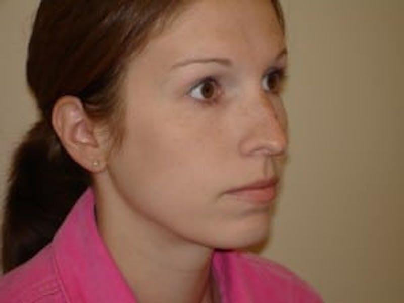 Rhinoplasty Before & After Gallery - Patient 133066731 - Image 5