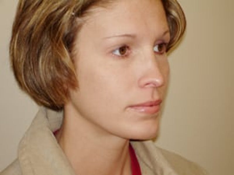 Rhinoplasty Before & After Gallery - Patient 133066731 - Image 6