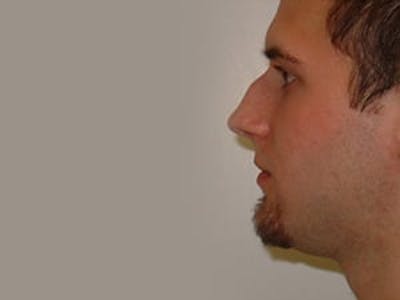 Rhinoplasty Before & After Gallery - Patient 133066732 - Image 1