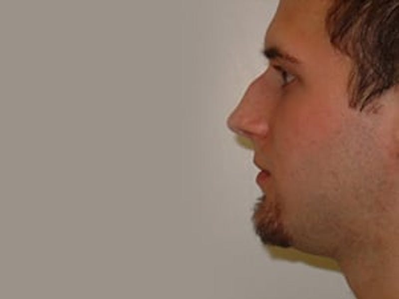 Rhinoplasty Before & After Gallery - Patient 133066732 - Image 1