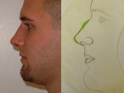 Rhinoplasty Before & After Gallery - Patient 133066732 - Image 2