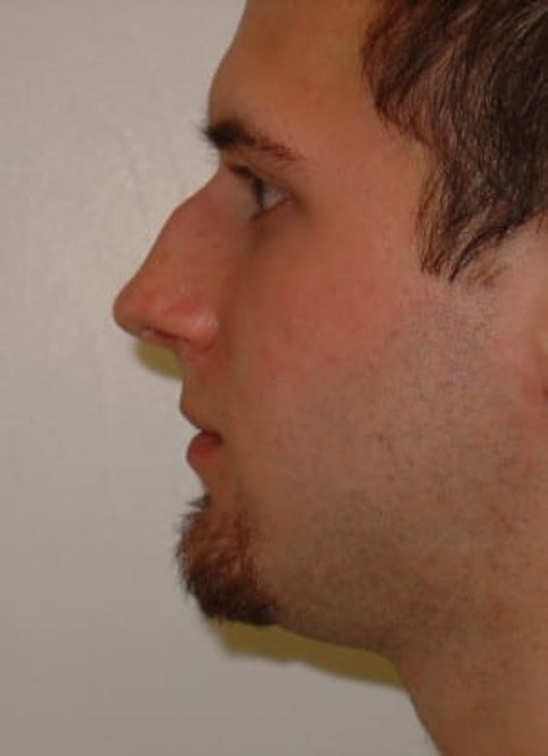 Rhinoplasty Before & After Gallery - Patient 133066732 - Image 3