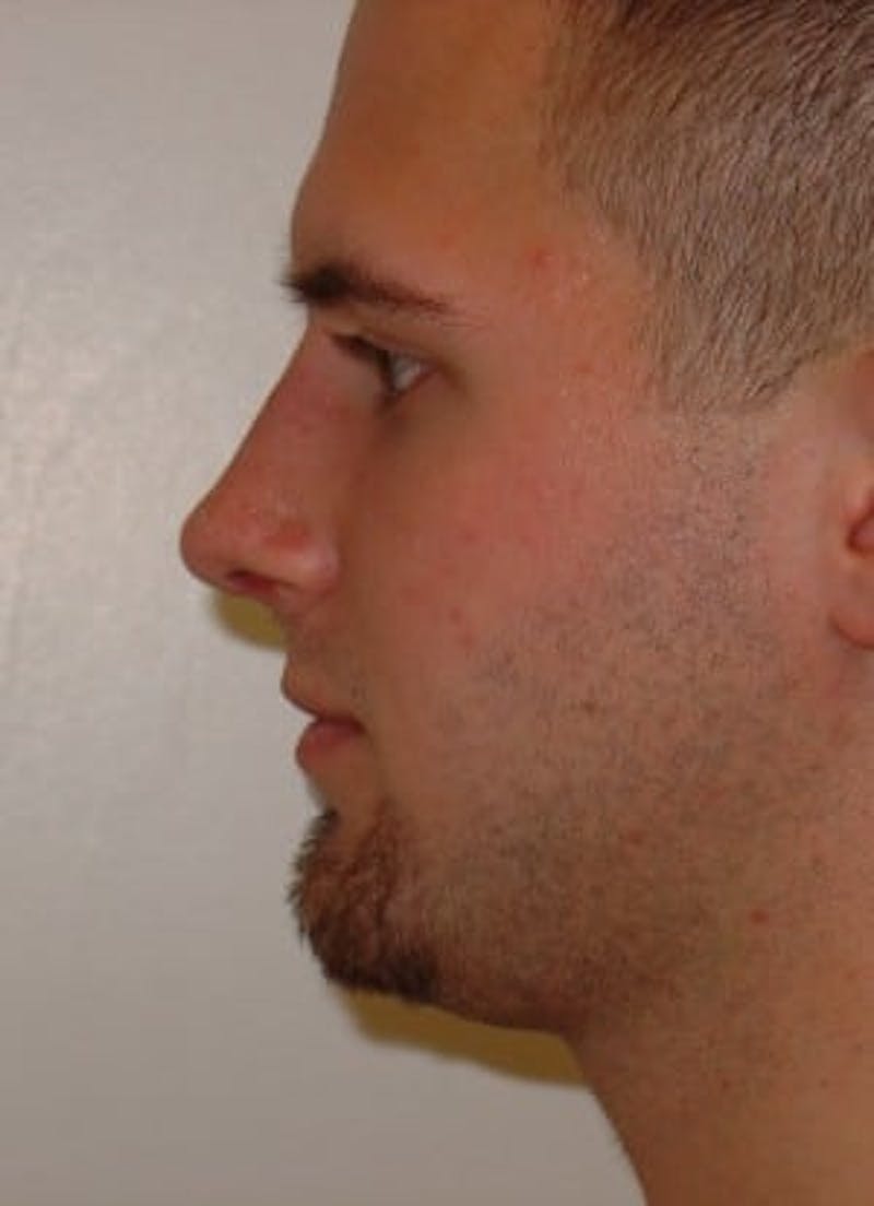 Rhinoplasty Before & After Gallery - Patient 133066732 - Image 4