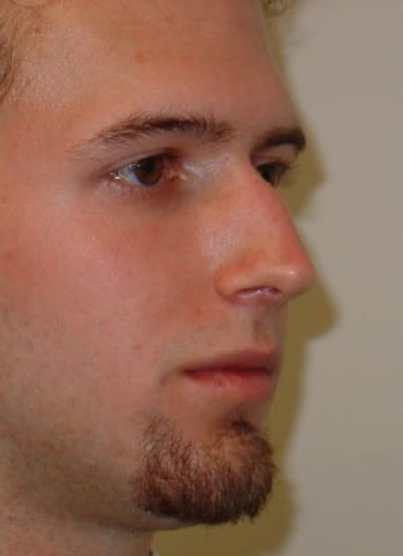 Rhinoplasty Before & After Gallery - Patient 133066732 - Image 5