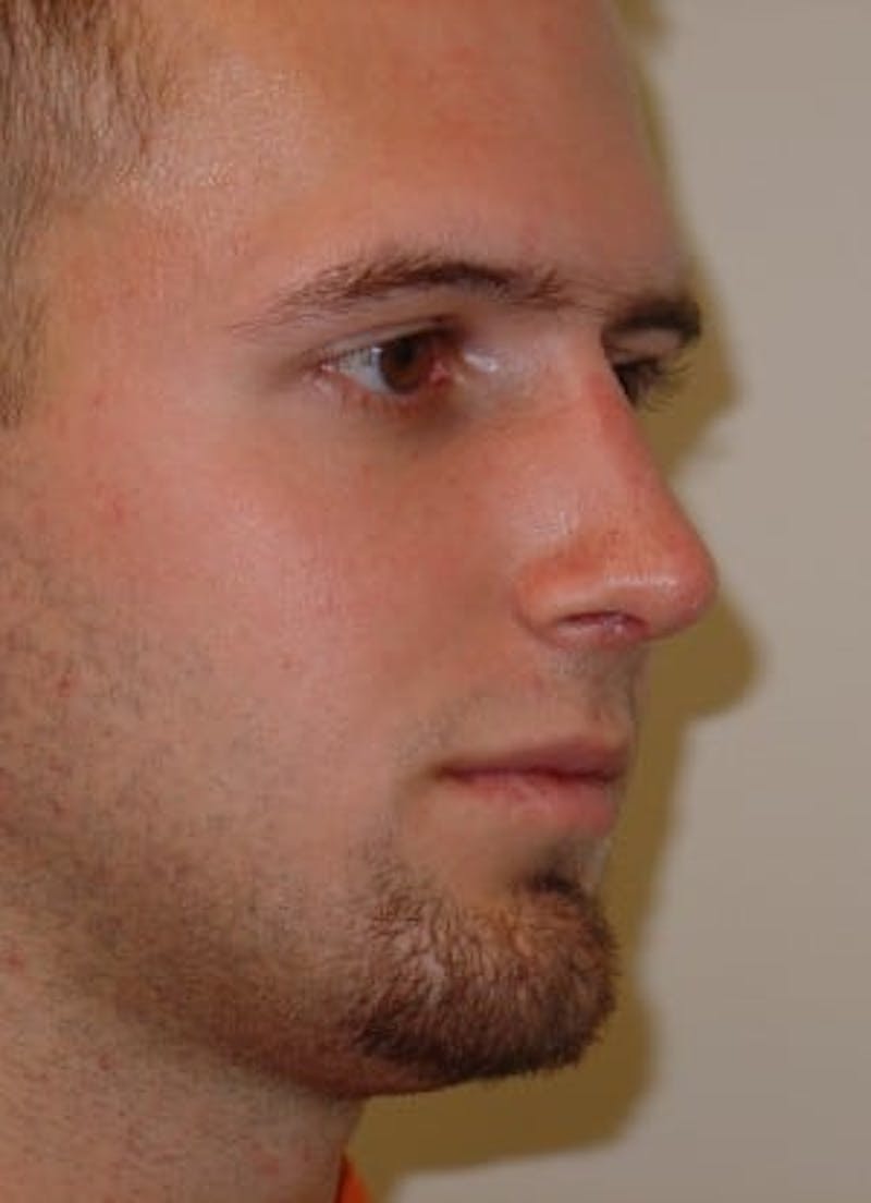 Rhinoplasty Before & After Gallery - Patient 133066732 - Image 6