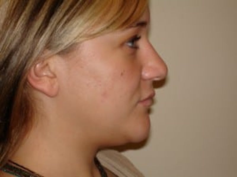Rhinoplasty Before & After Gallery - Patient 133066734 - Image 1