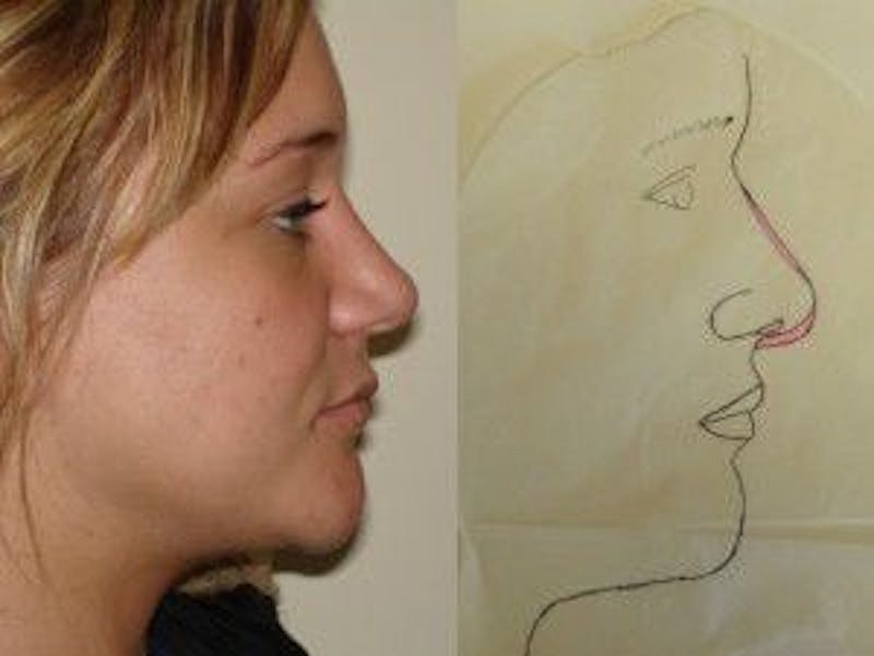 Rhinoplasty Before & After Gallery - Patient 133066734 - Image 2