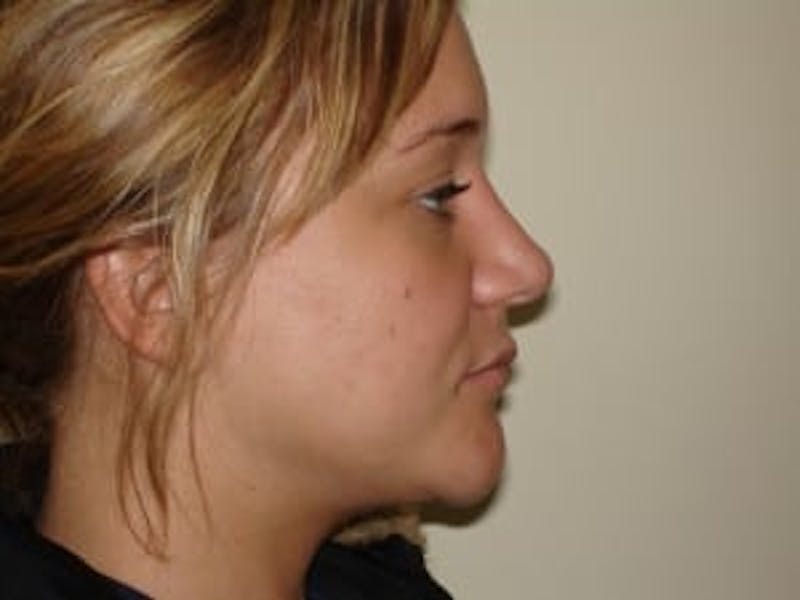 Rhinoplasty Before & After Gallery - Patient 133066734 - Image 4