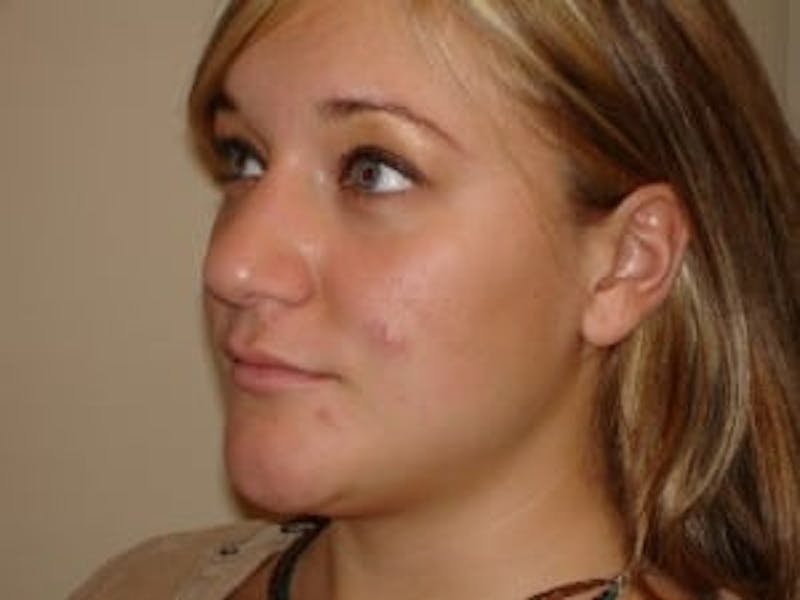 Rhinoplasty Before & After Gallery - Patient 133066734 - Image 5