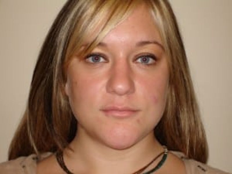 Rhinoplasty Before & After Gallery - Patient 133066734 - Image 7