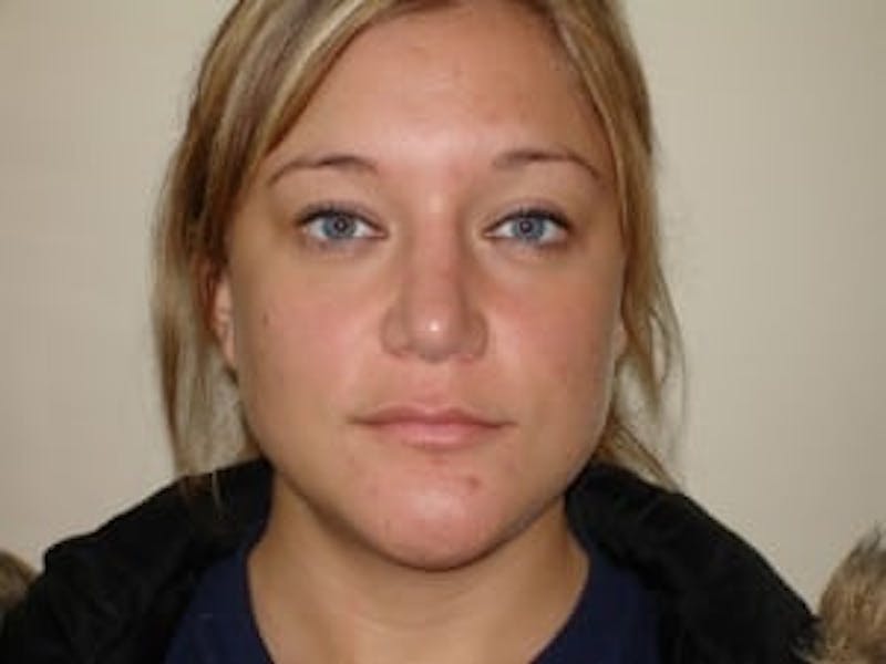 Rhinoplasty Before & After Gallery - Patient 133066734 - Image 8